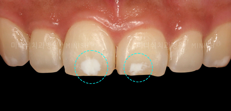white spots on teeth
