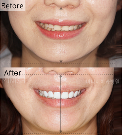 bruxism in korea minish teeth gangnam seoul